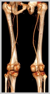 артерии нижних конечностей