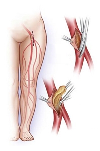 протезирование артерии